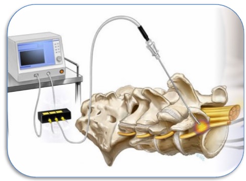 АБЛЯЦИЯ ПОЗВОНОЧНИКА (РЧА)